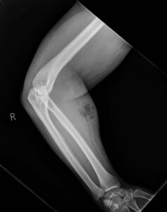 irlandes se inyecta semen en su brazo